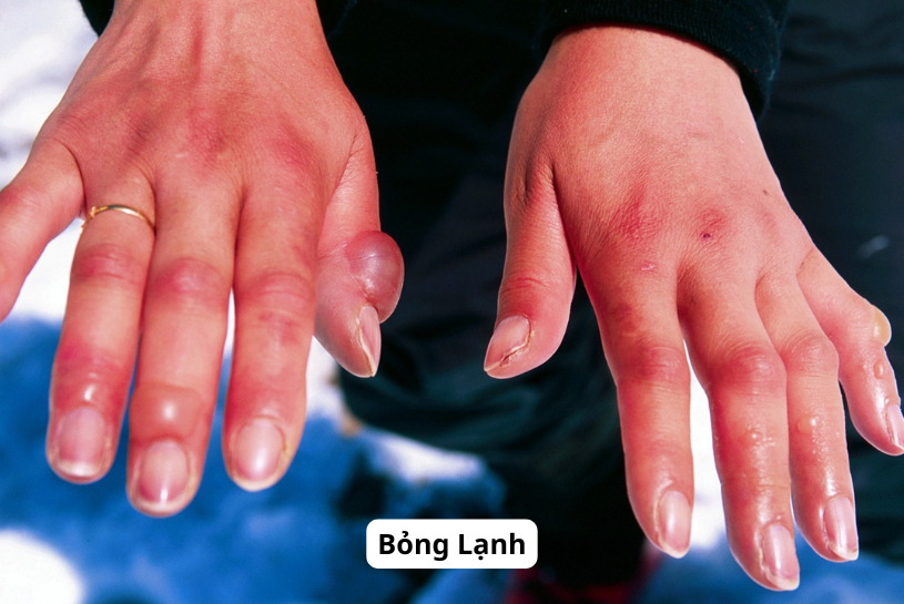 bỏng lạnh do bình chữa cháy